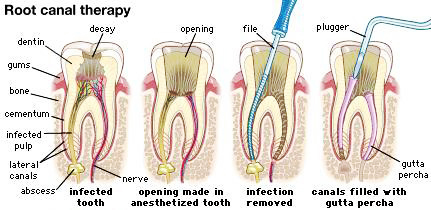 root-canal.jpg